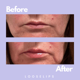 Before and After Photo showing lip transformation of a customer using the looselips lip lifter vegan formula.