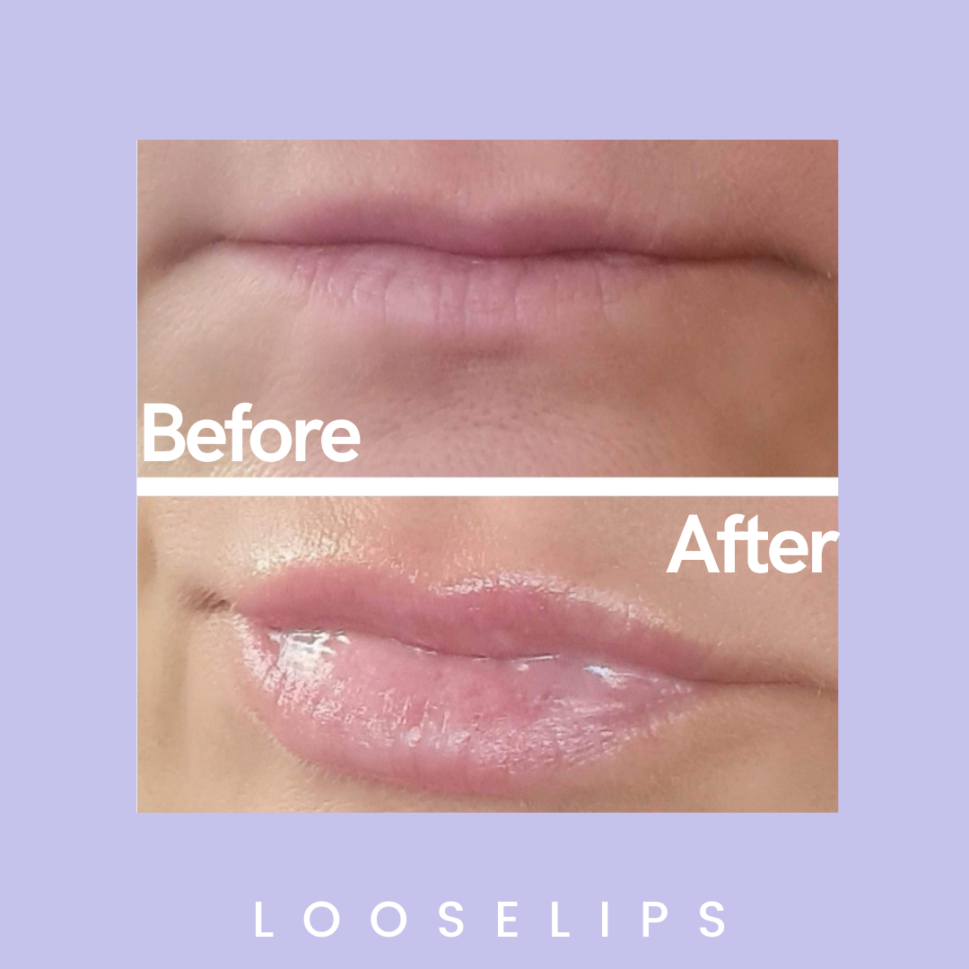 The Looselips Lip Lifter