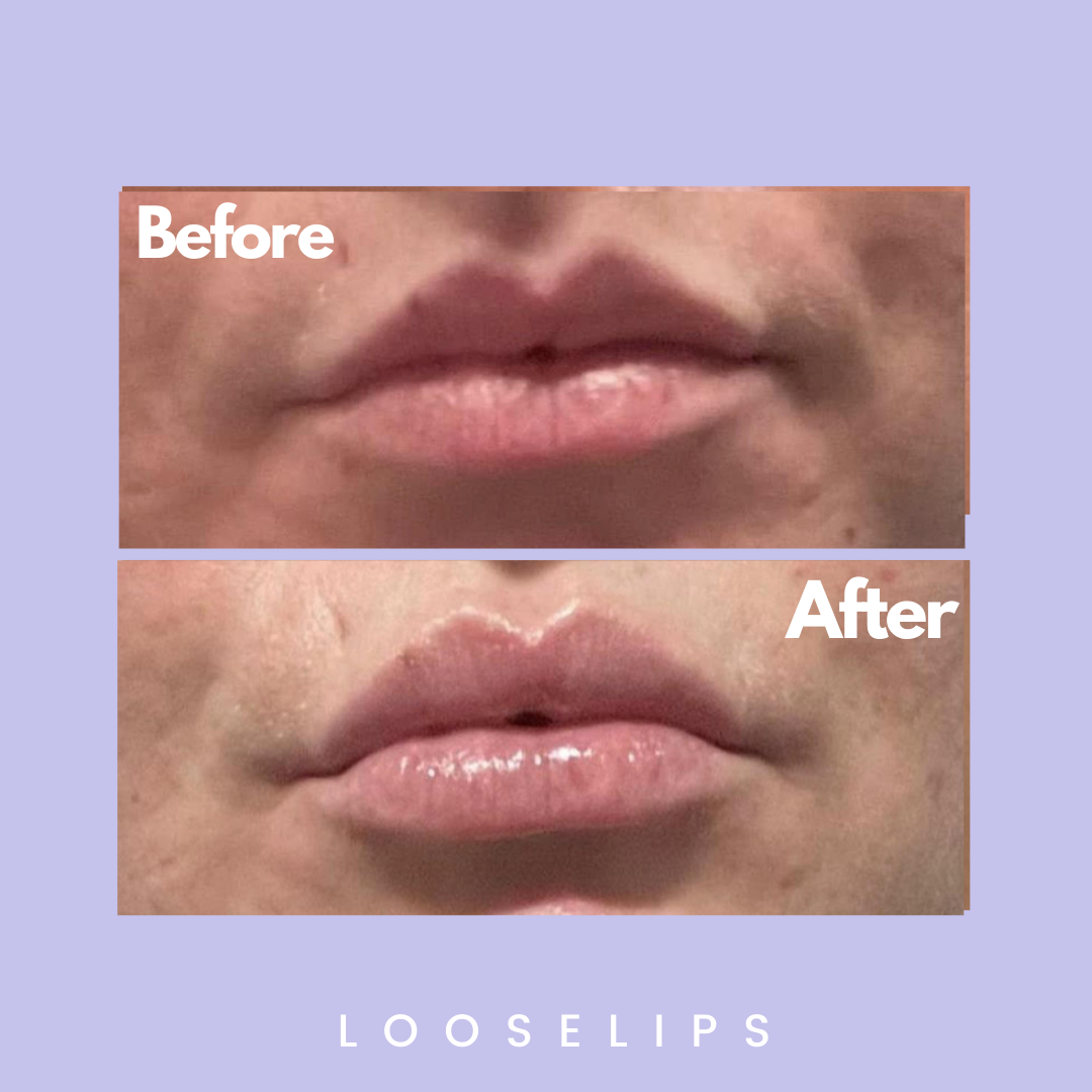 The Looselips Lip Lifter