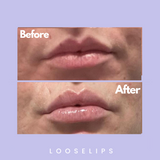 The Looselips Lip Lifter