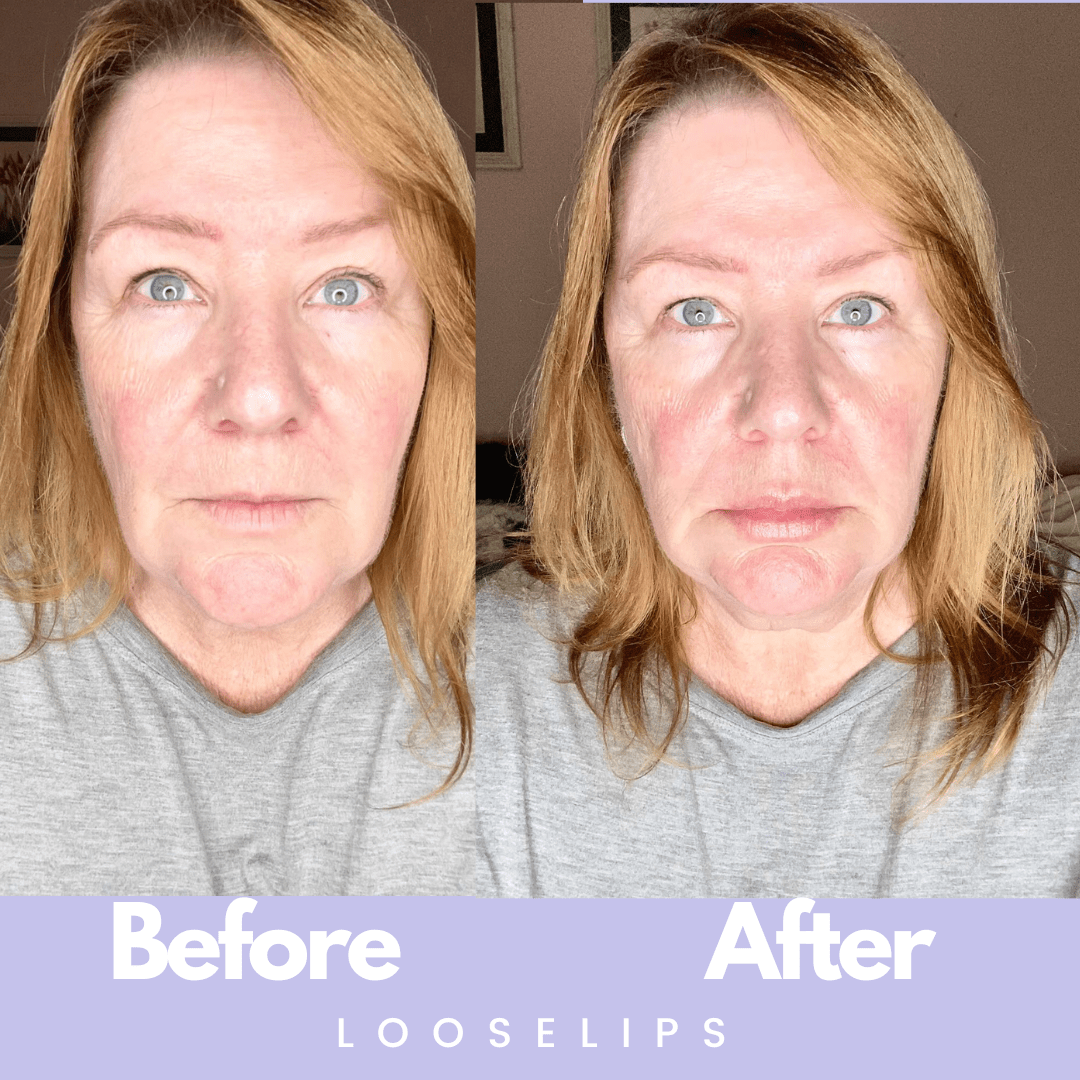 The Looselips Lip Lifter