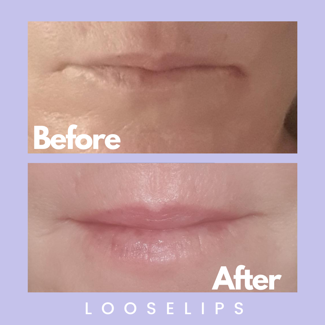 The Looselips Lip Lifter